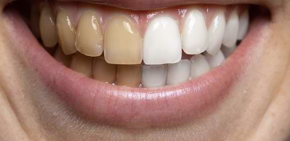 Cara Mengatasi Gigi Kuning agar Senyum Lebih Cerah dan Percaya Diri